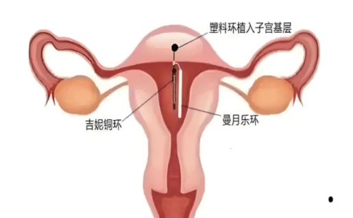 院网站-留住子宫——守护子宫的“魔法环”509