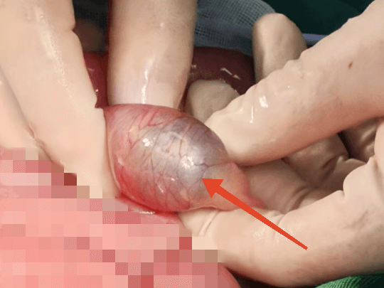 1龄童误食“水宝宝” 儿外科急救保安全93