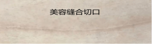 20260206【孕产印记·无痕守护 ▏剖宫产疤痕无痕化科普①】不只是“缝上”，更是“绣花”386