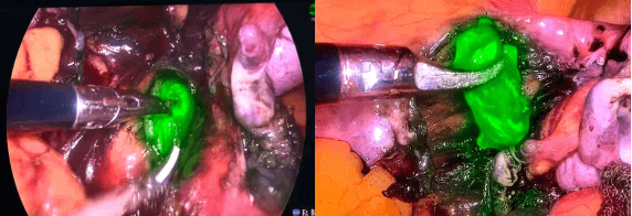 院网站-精准破局  微创护航！——淮南市妇幼保健院完成首例高难度内膜癌荧光显影腹腔镜手术591