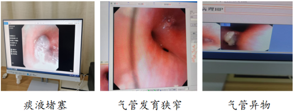 院网站-以镜为刃破解难题 助力儿童健康呼吸——淮南市妇幼保健院（市儿童医院）支气管镜技术1213