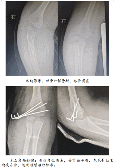 院网站-全市首例超声引导下肱骨外髁骨折闭合复位术在淮南市妇幼保健院（市儿童医院）成功开展780