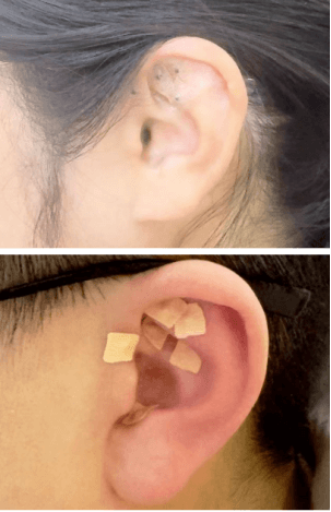 院网站-耳穴巧施催产力，自然分娩更顺利——绿色催产、中医守护开启温柔分娩新体验666